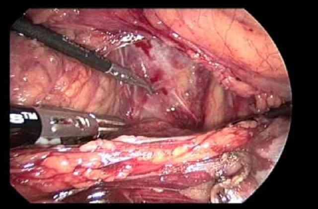 chirurgie laparoscopique radicale de la vessie
