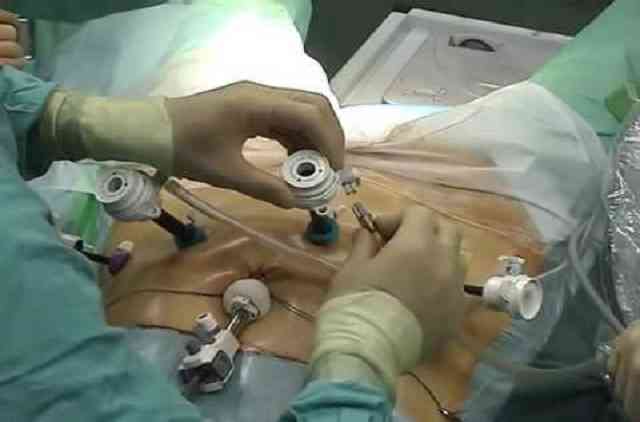 Chirurgie laparoscopique radicale de la prostate.jpg