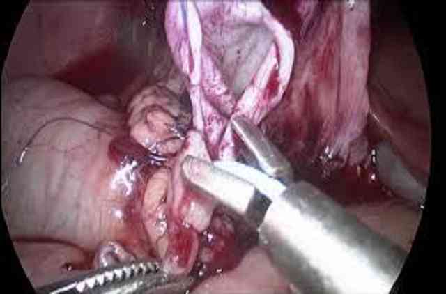 chirurgie laparoscopique de néphrectomie