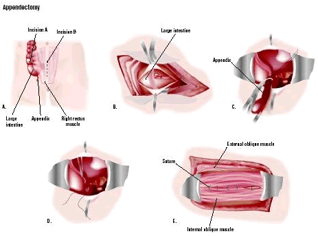 best surgeons top hospitals for low cost Hernia surgery in india