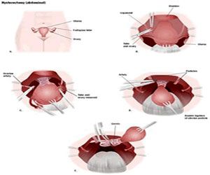 TOP HOSPITALS AND BEST SURGEONS FOR LAPAROSCOPIC HYSTERECTOMY SURGERY IN INDIA