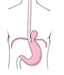 Hiatus Hernia Repair Surgery