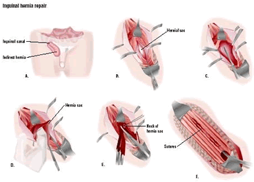 This patient has an indirect inguinal hernia (A). To repair it, the surgeon makes an incision over the area and separates the muscle and tisses to expose the hernia sac (B). The sac is cut open (C), and the contents are replaced into the abdomen (D). The neck of the hernia sac is tied off (E), and the muscles and tissues are sutured (F). (Illustration by GGS Inc.)