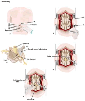 Dans cette laminectomie lombaire postérieure (depuis le dos), une incision est faite dans le dos du patient au niveau des vertèbres lombaires (A). La plaie est ouverte à l'aide de rétracteurs afin d'exposer les vertèbres L2 et L3 (B). Un morceau d'os au dos des vertèbres est retiré (C et D), permettant de réparer un disque endommagé (E). (Illustration par GGS Inc.)