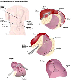 Low Cost Acid Reflux Surgery in India