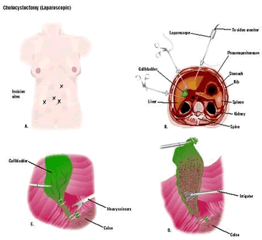Low Cost Cholecystectomy Surgery in India