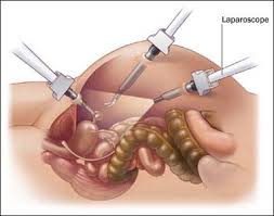 low cost gynecologic surgery in india