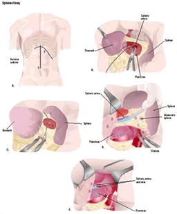 low cost splenectomy surgery in india