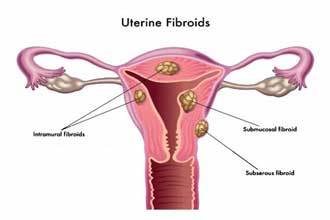 Low Cost Uterus Surgery In India
