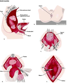 Un tumor au rectum ou dans le côlon inférieur peut être retiré par une résection rectale (A). Une incision est faite autour de l'anus du patient (B). Le tumor est tiré vers le bas à travers l'incision (C). Une zone attachée du côlon est également retirée (D). L'aire est réparée, laissant un orifice pour l'élimination des selles (E). (Illustration par GGS Inc.)