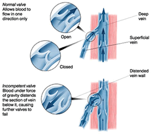 vericose-vein4