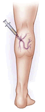 vericose-vein5
