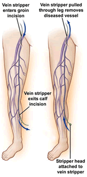 vericose-vein6
