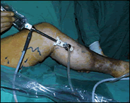 vericose-vein7