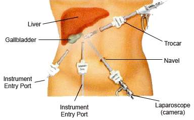 Inde Chirurgie laparoscopique